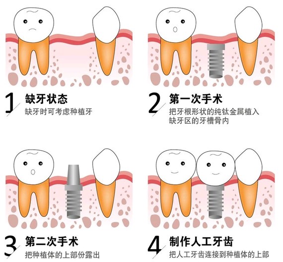 种牙领域最新进展与创新技术概览